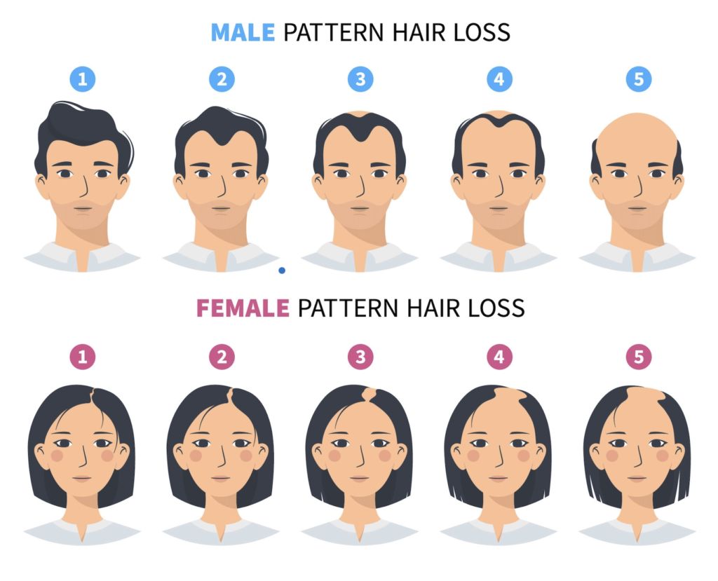 Male and female baldness